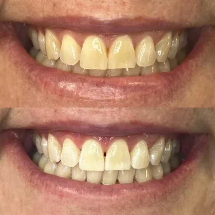 teeth whitening Perth