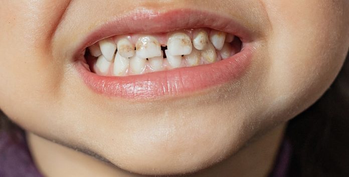Baby teeth have thinner enamel